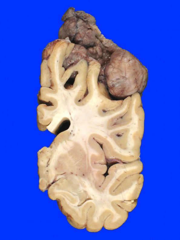 14A9 Meningioma, atypical (Case 14)_13