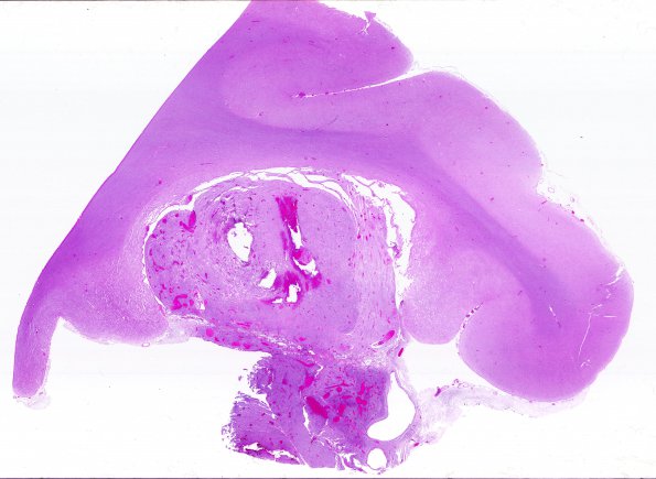 14B1 Meningioma, atypical (Case 14) EMA H&E WM L33 2