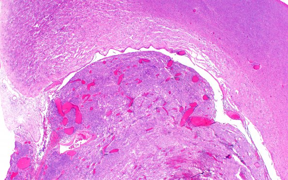 14B2 Meningioma, atypical (Case 14) EMA H&E WM L33 4X