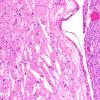 14B3 Meningioma, atypical (Case 14) L33 H&E 10X