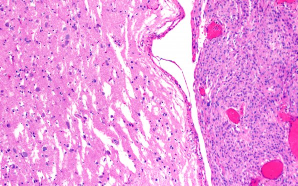 14B3 Meningioma, atypical (Case 14) L33 H&E 10X