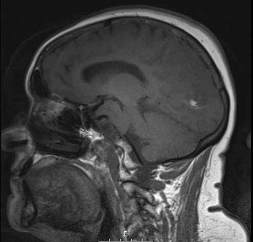 15A1 Meningioma, anaplastic (Case 15) T1 noC 12-22 - Copy