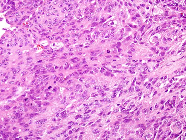 15C1 Meningioma, anaplastic (Case 15) H&E 12