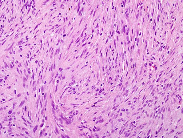 15C2 Meningioma, anaplastic (Case 15) H&E 11