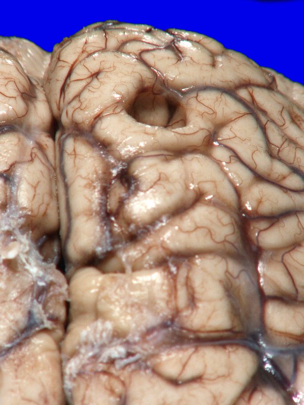 16A2 Meningioma, incidental gross_1