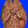 17A1 Meningioma (Case 17) Gross 8