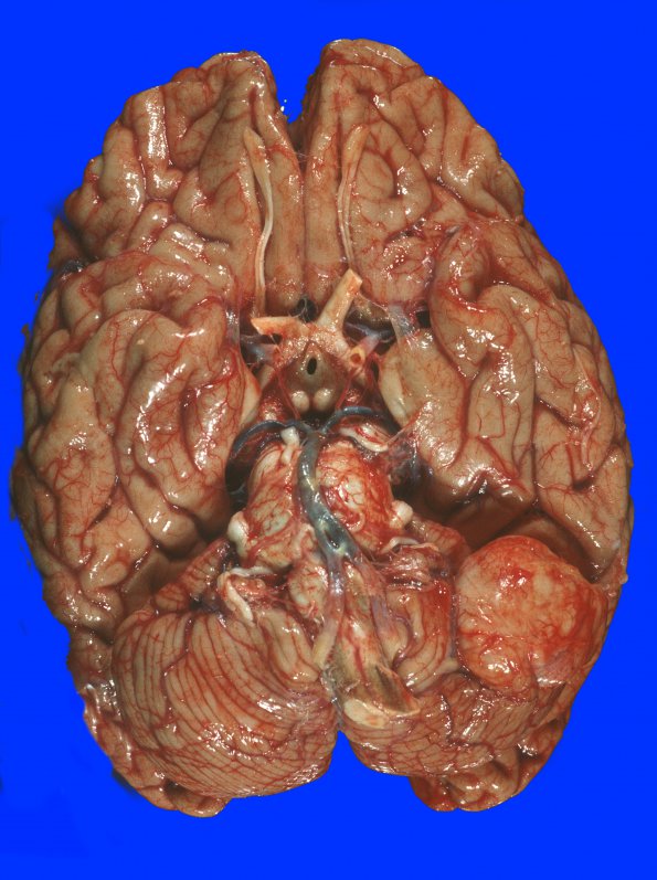 17A1 Meningioma (Case 17) Gross 8