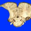 17A10 Meningioma (Case 17) Gross 6