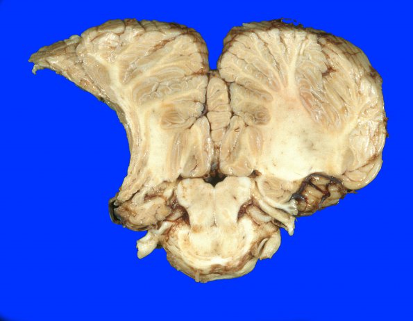 17A10 Meningioma (Case 17) Gross 6