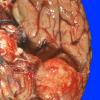 17A2 Meningioma (Case 17) Gross 9