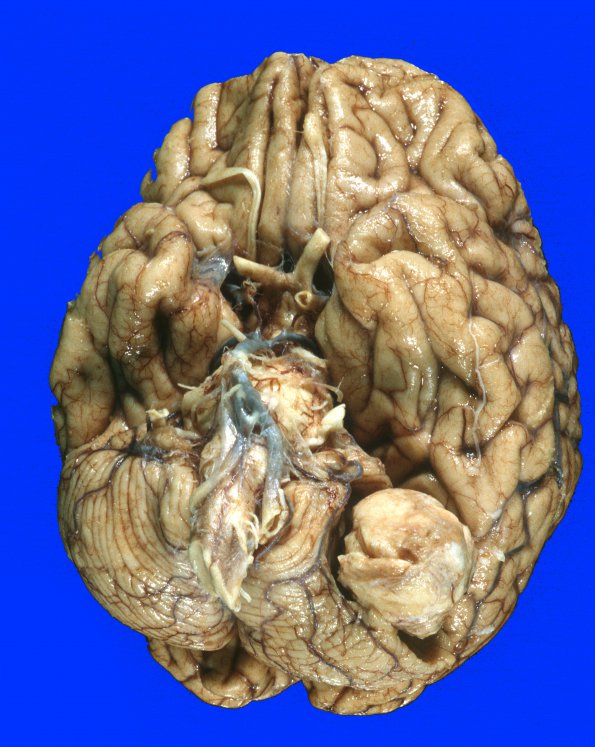 17A3 Meningioma (Case 17) Gross 10