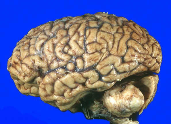 17A4 Meningioma (Case 17) Gross 11