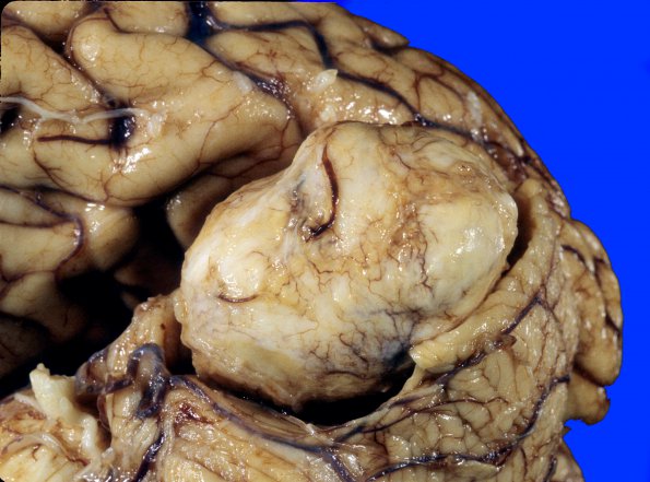 17A5 Meningioma (Case 17) A1