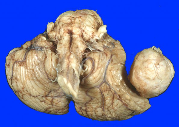 17A6 Meningioma (Case 17) Gross 7