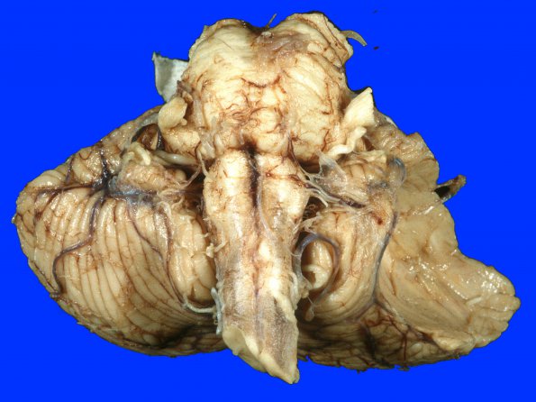 17A7 Meningioma (Case 17) 4A