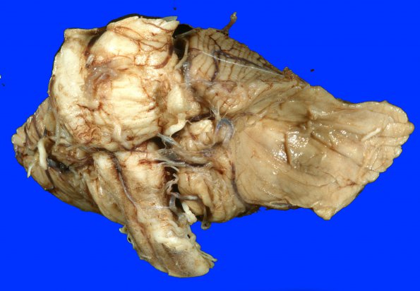 17A8 Meningioma (Case 17) 2A