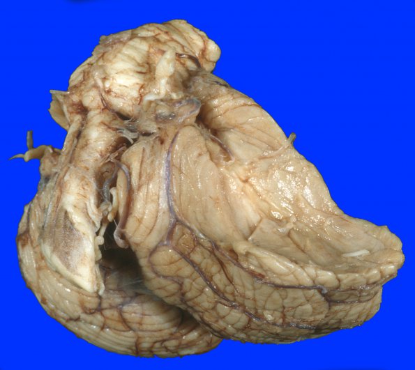 17A9 Meningioma (Case 17) Gross 13