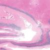 17B1 Meningioma (Case 17) N9 H&E 2X