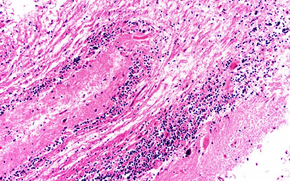 17B2 Meningioma (Case 17) N9 H&E 20X