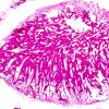 18A1 Meningioma, bone invasion (Case 18)  c