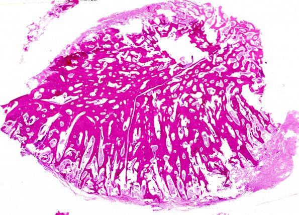 18A1 Meningioma, bone invasion (Case 18)  c