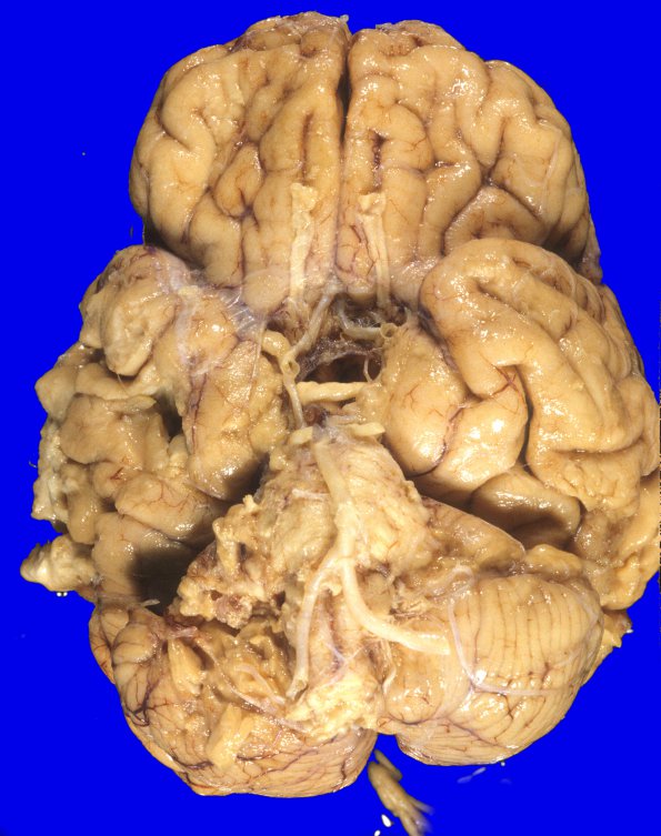 19A1 Meningioma, WHO II, brain invasion (Case 19) 1