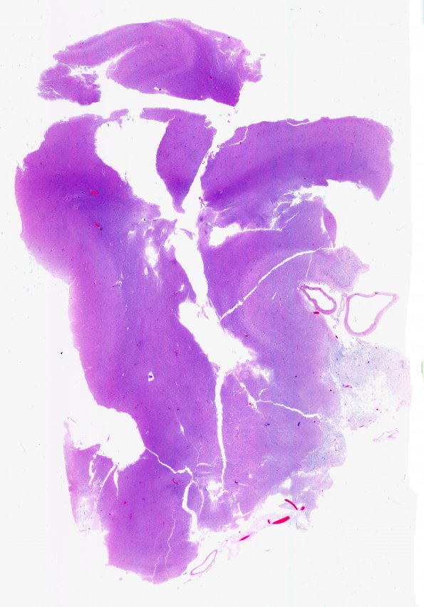 19B1 Meningioma, WHO II, brain invasion (Case 19) N14 H&E WM