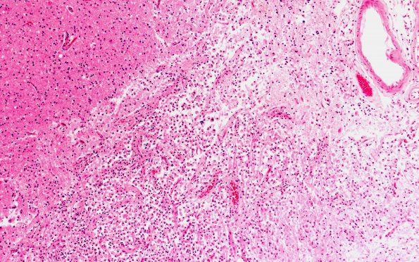 19B2 Meningioma, WHO II, brain invasion (Case 19) N14 H&E 10X