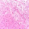 19B3 Meningioma, WHO II, brain invasion (Case 19) N14 20X