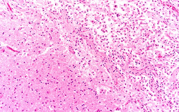 19B3 Meningioma, WHO II, brain invasion (Case 19) N14 20X