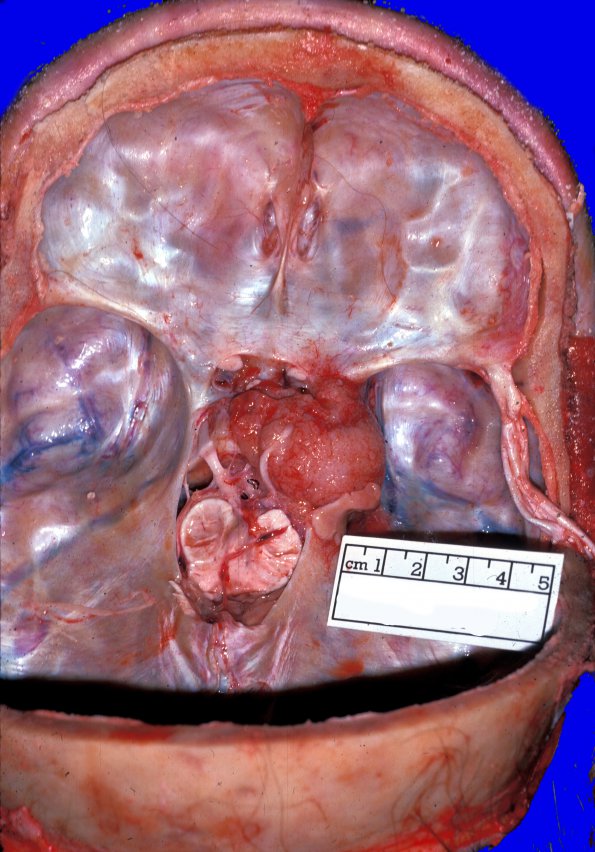 1A1 Meningioma (Case 1) 5