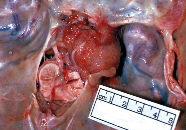 1A2 Meningioma (Case 1) 6