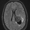 20A1 Meningioma, intraventricular (Case 20) FLAIR - Copy - Copy