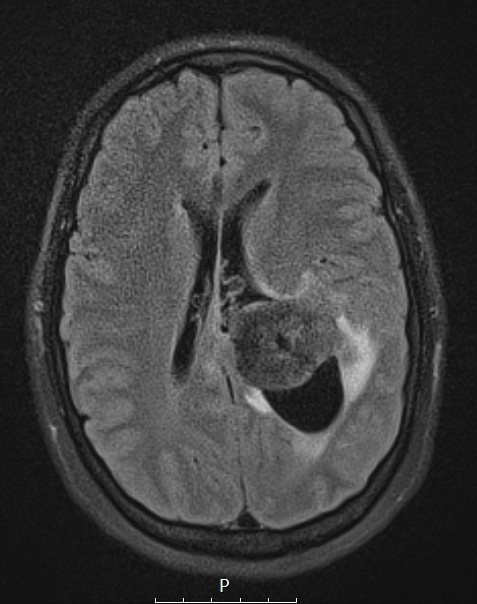 20A1 Meningioma, intraventricular (Case 20) FLAIR - Copy - Copy