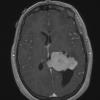 20A2 Meningioma, intraventricular (Case 20) T1W - Copy - Copy