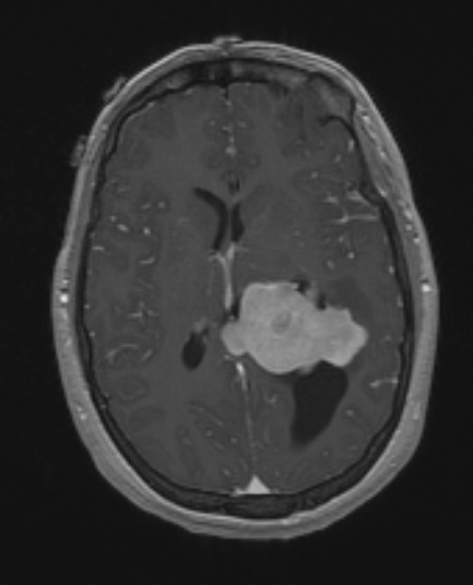 20A2 Meningioma, intraventricular (Case 20) T1W - Copy - Copy