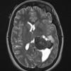 20A4 Meningioma, intraventricular T2W (Case 20) axial - Copy - Copy