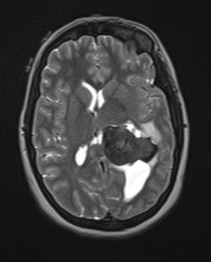 20A4 Meningioma, intraventricular T2W (Case 20) axial - Copy - Copy