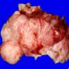 20B1 Meningioma, intraventricular (Case 20) _1