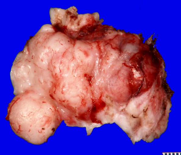 20B1 Meningioma, intraventricular (Case 20) _1