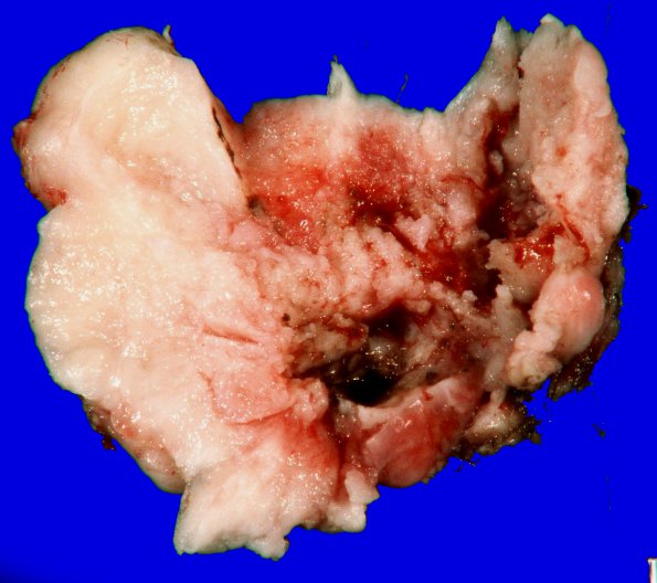 20B2 Meningioma, intraventricular (Case 20) _2