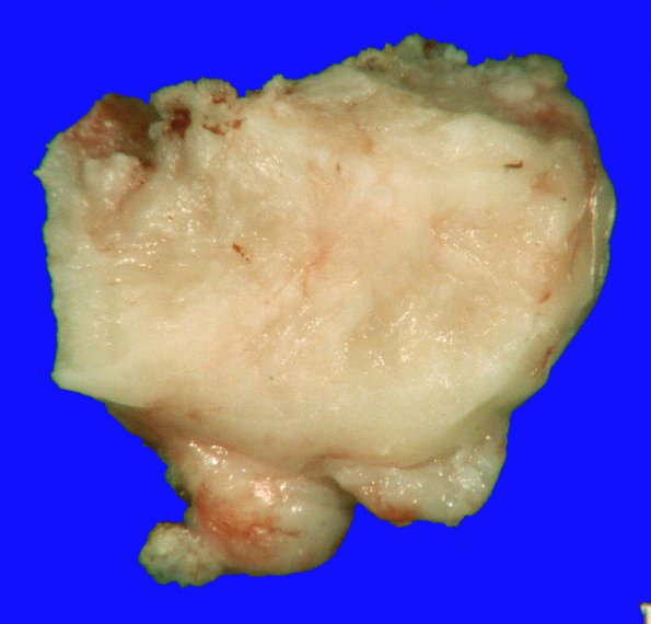 20B3 Meningioma, intraventricular (Case 20) _9