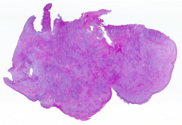 20C1 Meningioma, intraventricular (Case 20)