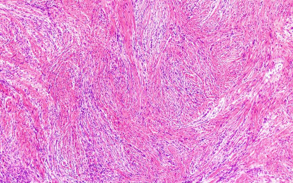 20C2 Meningioma, intraventricular (Case 20) H&E 10X