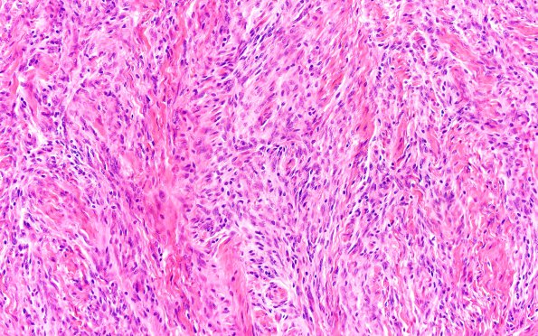 20C3 Meningioma, intraventricular (Case 20) H&E 20X