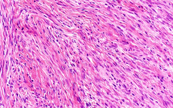 20C4 Meningioma, intraventricular (Case 20) H&E 40X