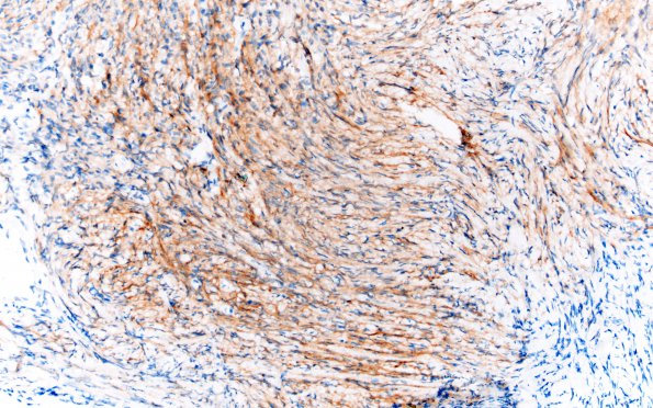 20D Meningioma, intraventricular (Case 20) EMA 20X