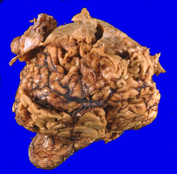 21A1 Meningioma, WHOII, brain invasion (Case 21) 2A