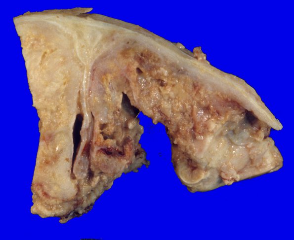 21A2 Meningioma, WHO II, brain invasion (Case 21) 1