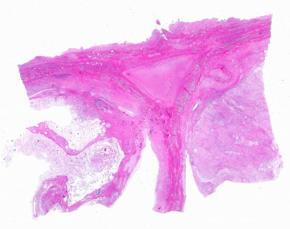 21B1 Meningioma, WHOII, brain invasion (Case 21) N16 WM